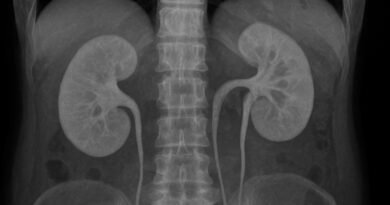 Caso Raro: Un Paciente, Tres Riñones