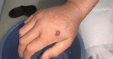 First confirmed case of anthrax and brucellosis co-infection reported in China