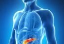 Rare Pancreatic Cancer Diagnosed in Patient With Kaposi Sarcoma