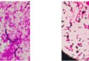 Irish Scientists Report First Known Case of Dual Trichosporon inkin Infection After Lung Transplant