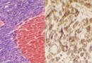 First reported paediatric case of a rare cardiac tumour discovered in a 12-year-old girl