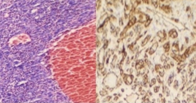 First reported paediatric case of a rare cardiac tumour discovered in a 12-year-old girl