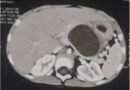 Rare Case: Congenital Pancreatic Pseudocyst Recurs After Surgery in Three-Year-Old Child