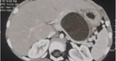 Rare Case: Congenital Pancreatic Pseudocyst Recurs After Surgery in Three-Year-Old Child