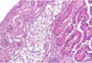 Two Cancers in One Kidney: A Rare Case That Challenged Diagnosis