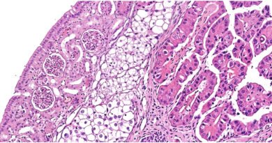 Two Cancers in One Kidney: A Rare Case That Challenged Diagnosis